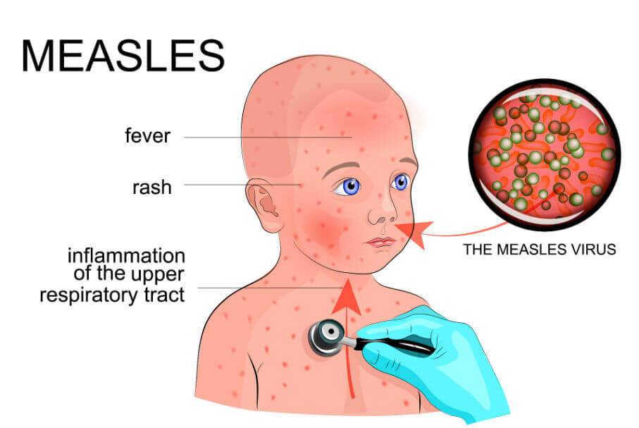 An illustration shows a drawing of a male child with measles symptoms, including red dots to symbolize a rash and red skin to symbolize a high fever.