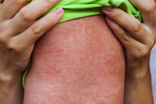 The stomach of a child wearing a green shirt, and who is being held up by two adult hands, is shown with a red bumpy measles rash.